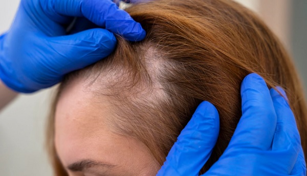 Saç dökülmesi neden olur