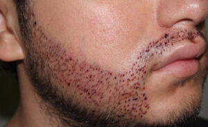 Sakal Ekimi Köselik Sorun Yaşayan Erkekler için Çözüm mü?